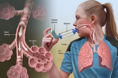 Asthma patients treatment Hyderabad